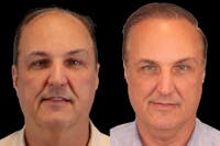 Hair Transplant Before & After Gallery - Patient 650614 - Image 1
