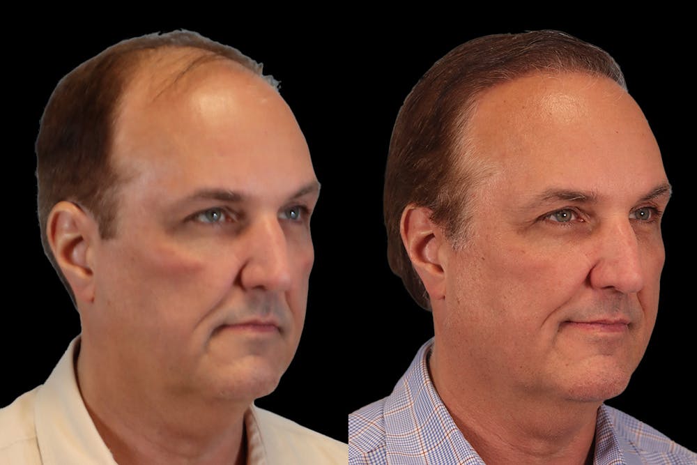 Hair Transplant Before & After Gallery - Patient 650614 - Image 2