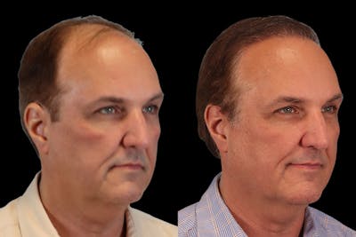 Hair Transplant Before & After Gallery - Patient 650614 - Image 2