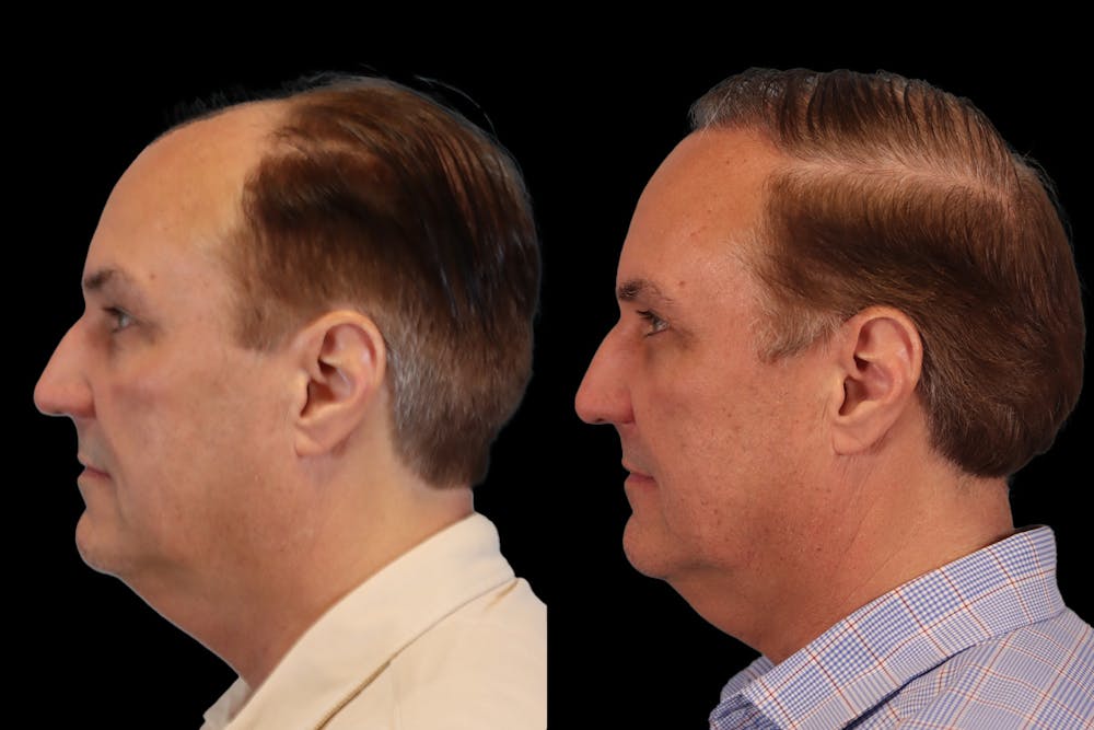 Hair Transplant Before & After Gallery - Patient 650614 - Image 5