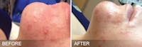 SkinPen Microneedling Before & After Gallery - Patient 5698316 - Image 1