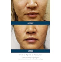SkinPen Microneedling Before & After Gallery - Patient 5698315 - Image 1