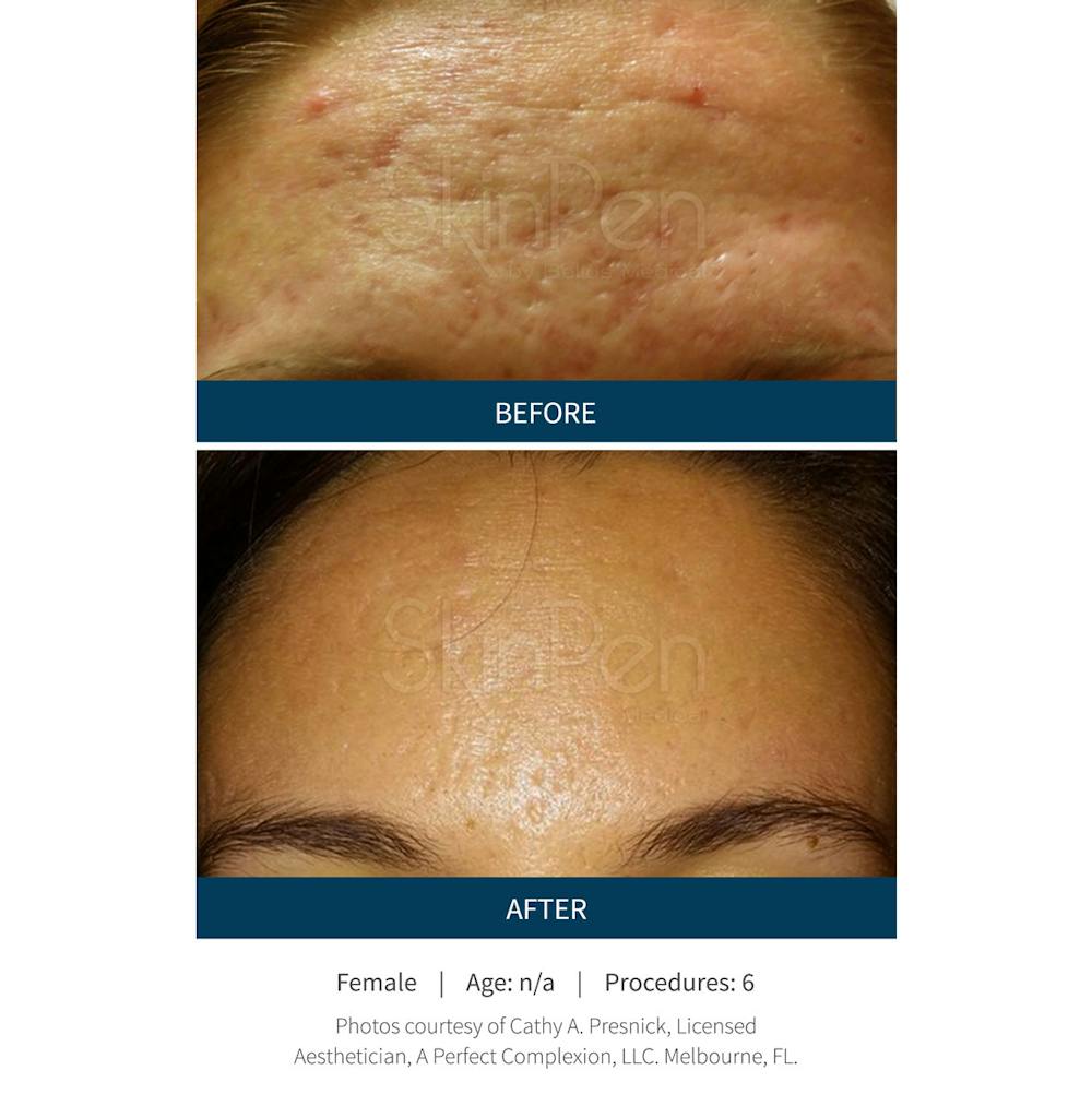 SkinPen Microneedling Before & After Gallery - Patient 5698313 - Image 1
