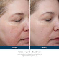 SkinPen Microneedling Before & After Gallery - Patient 5698314 - Image 1