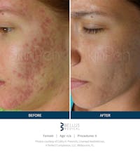 SkinPen Microneedling Before & After Gallery - Patient 5698312 - Image 1