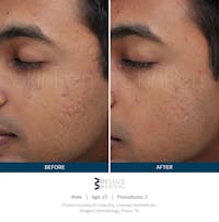 SkinPen Microneedling Before & After Gallery - Patient 5698311 - Image 1