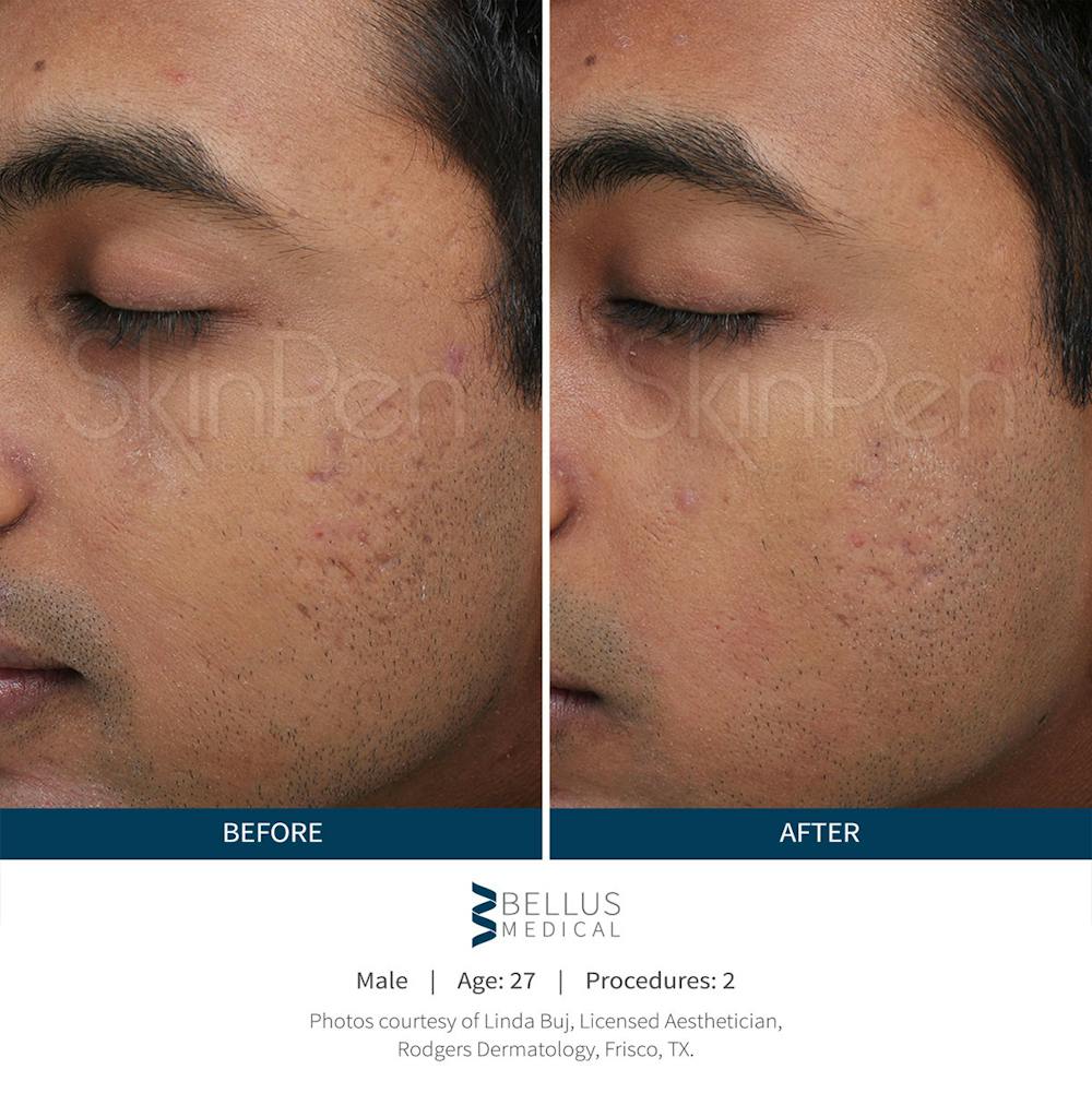 SkinPen Microneedling Before & After Gallery - Patient 5698311 - Image 1