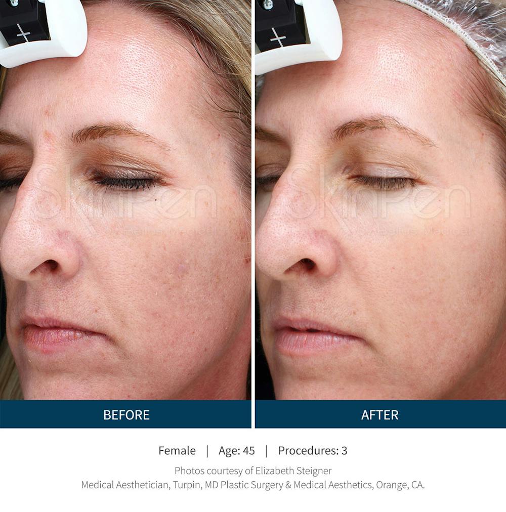 SkinPen Microneedling with PRP