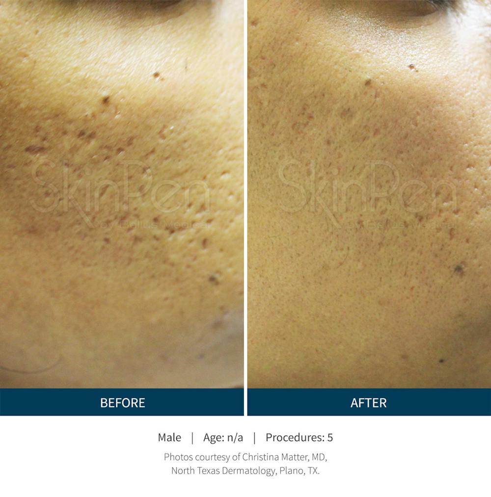 SkinPen Microneedling Before & After Gallery - Patient 5698319 - Image 1
