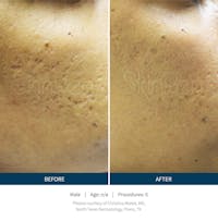 SkinPen Microneedling Before & After Gallery - Patient 5698319 - Image 1