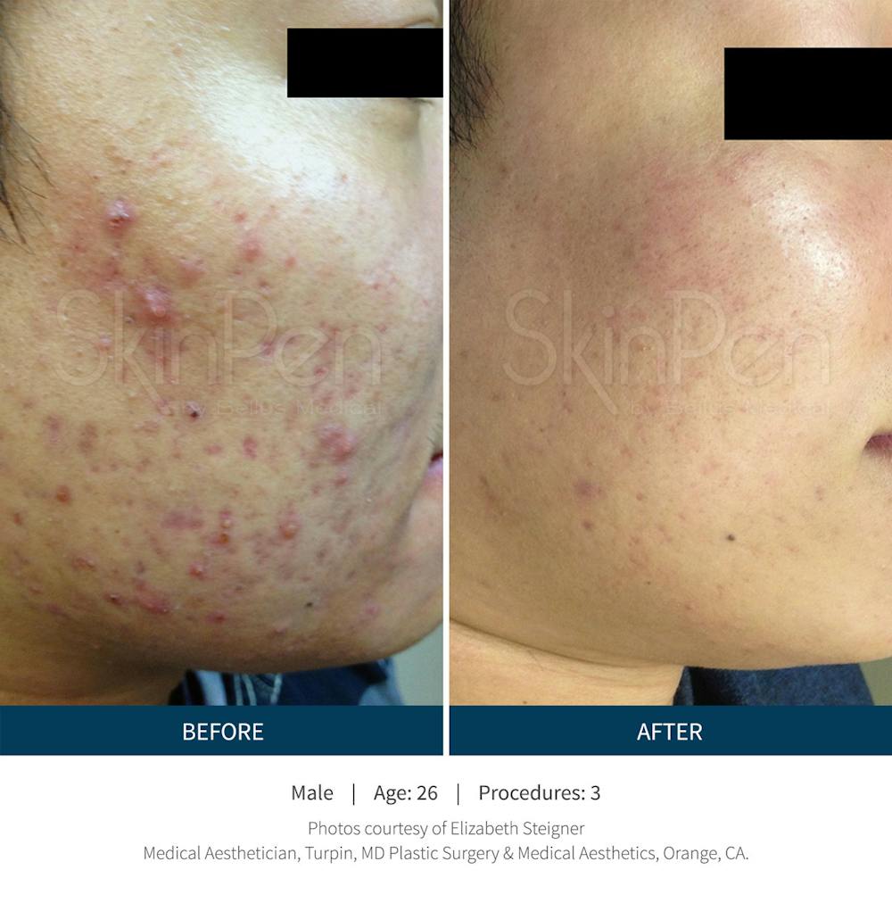 SkinPen Microneedling Before & After Gallery - Patient 5698318 - Image 1