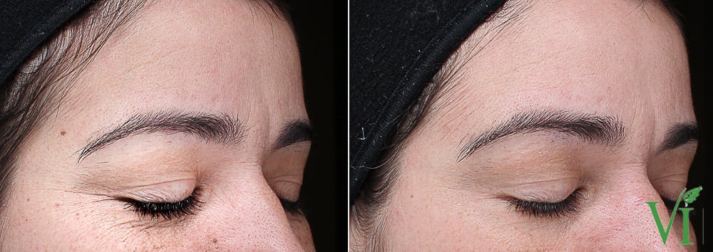 VI Peel Before & After Gallery - Patient 374614 - Image 1