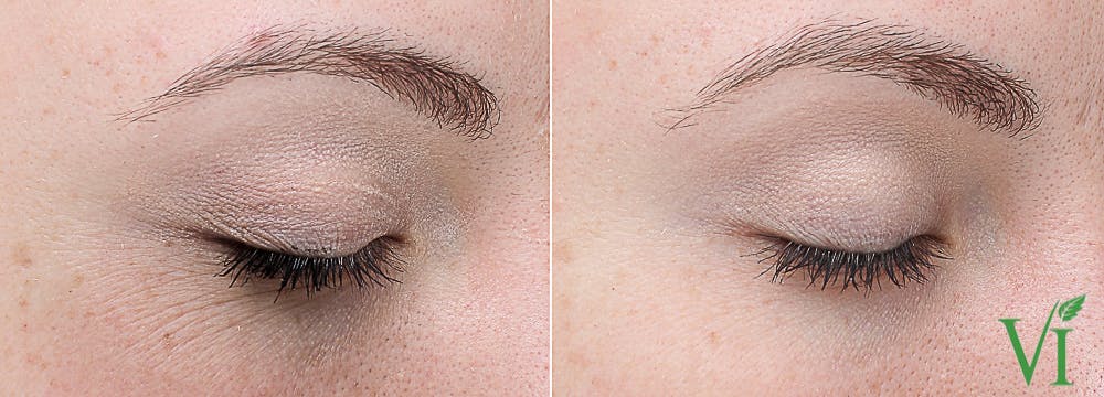 Chemical Peels Before & After Gallery - Patient 425211 - Image 1