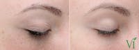 Chemical Peels Before & After Gallery - Patient 425211 - Image 1