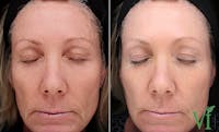 VI Peel Before & After Gallery - Patient 348187 - Image 1