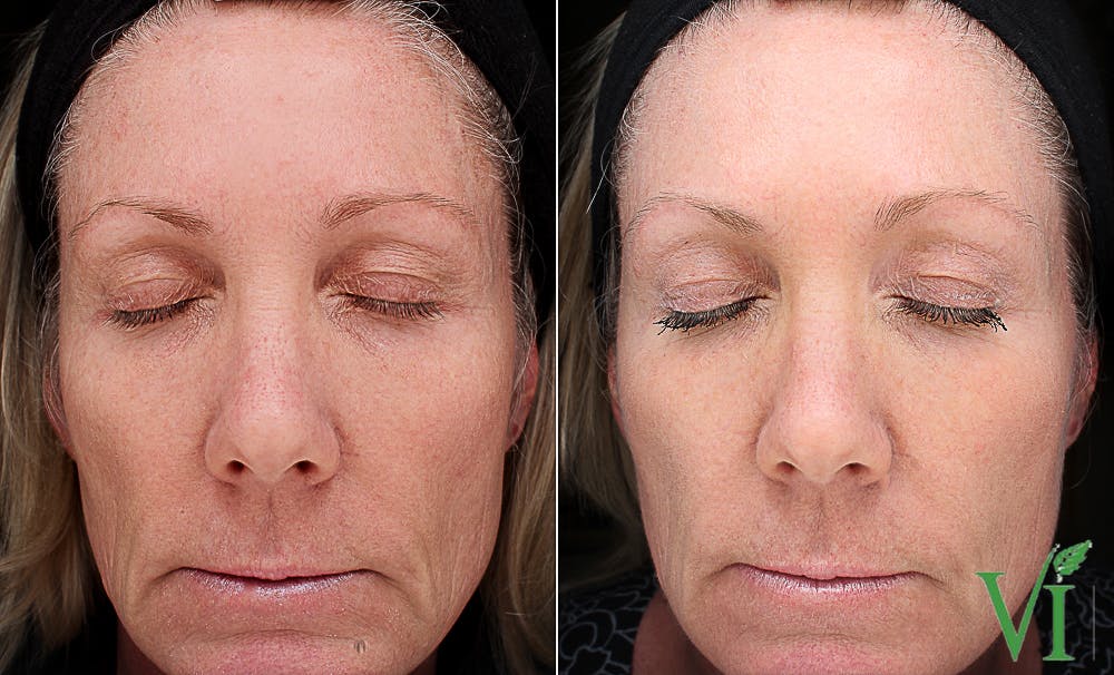 VI Peel Before & After Gallery - Patient 348187 - Image 1