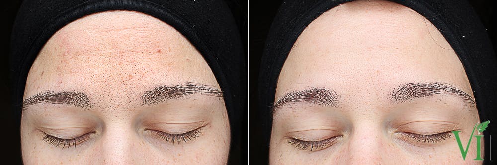 Anti Aging Before & After Gallery - Patient 5640656 - Image 1
