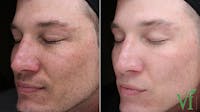 Chemical Peels Before & After Gallery - Patient 150180 - Image 1