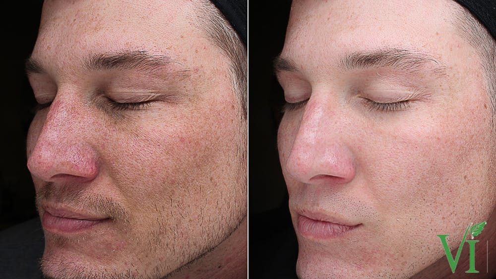 VI Peel Before & After Gallery - Patient 150180 - Image 1