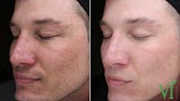 Anti Aging Gallery - Patient 5640662 - Image 1