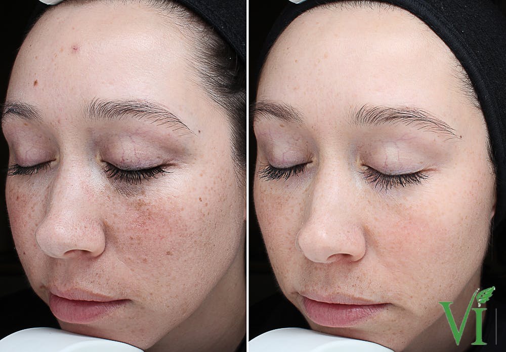 VI Peel Before & After Gallery - Patient 299448 - Image 1