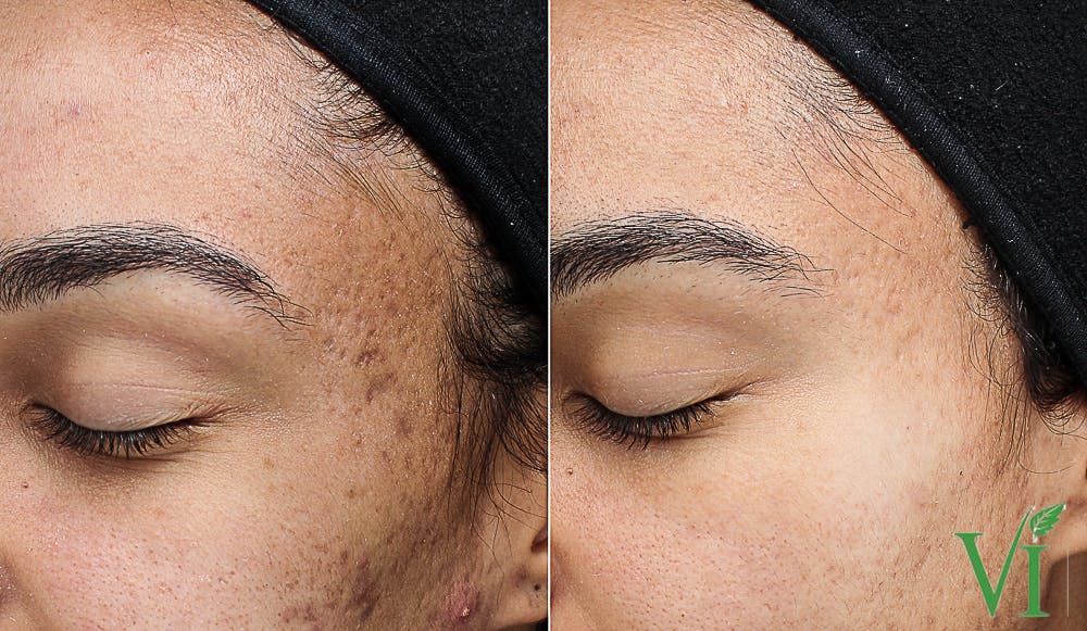 Chemical Peels Before & After Gallery - Patient 219062 - Image 1