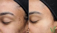 Chemical Peels Before & After Gallery - Patient 219062 - Image 1