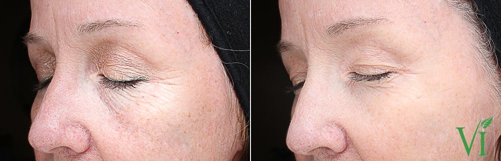 Chemical Peels Before & After Gallery - Patient 273338 - Image 1