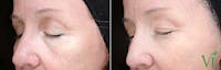 VI Peel Before & After Gallery - Patient 273338 - Image 1