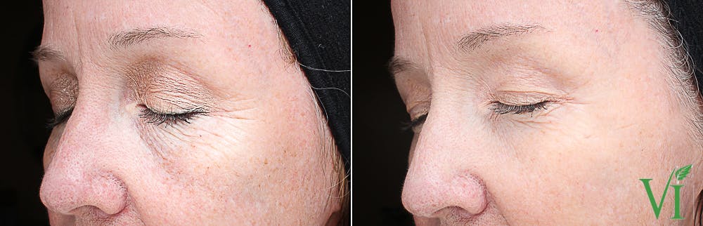 VI Peel Before & After Gallery - Patient 273338 - Image 1