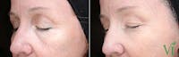 Anti Aging Before & After Gallery - Patient 5640693 - Image 1