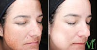 Pigmentation Before & After Gallery - Patient 5640705 - Image 1