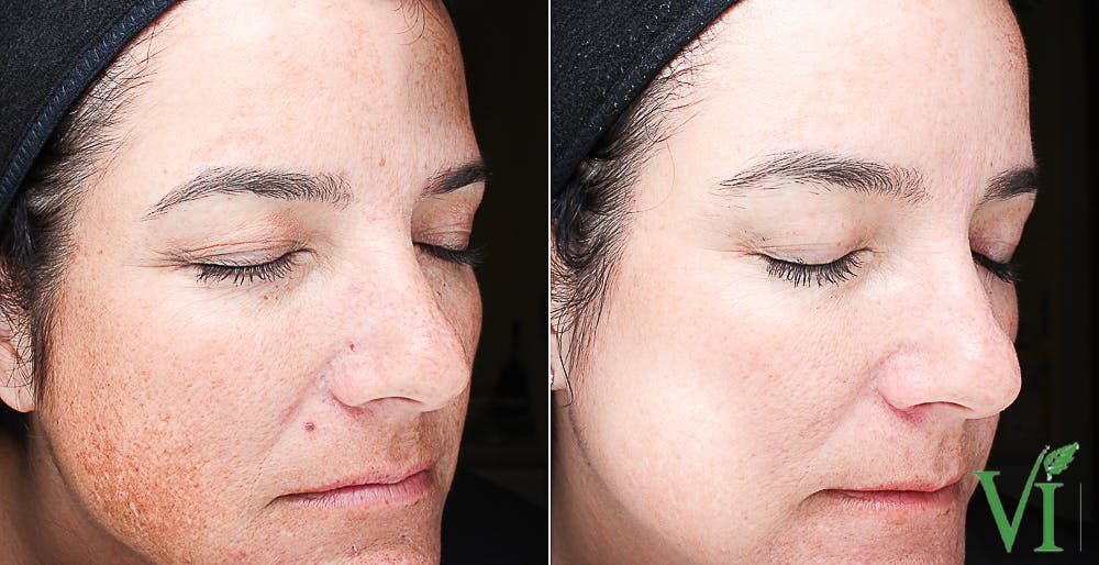 Pigmentation Before & After Gallery - Patient 5640705 - Image 1