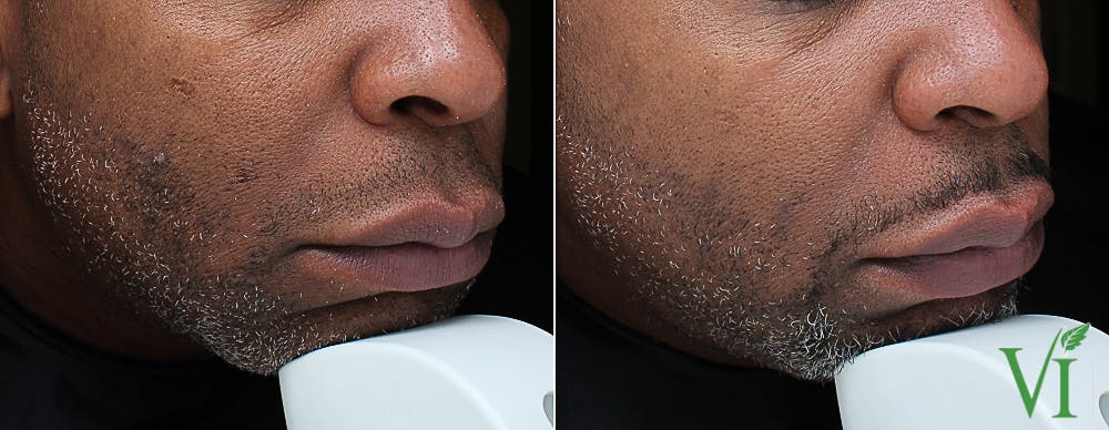 Pigmentation Before & After Gallery - Patient 5640706 - Image 1