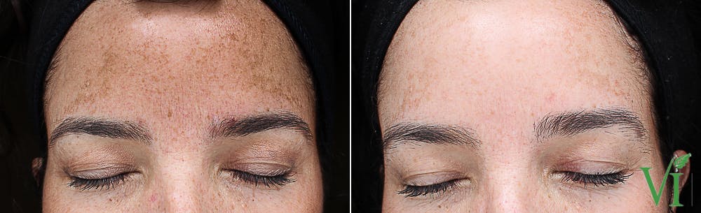 Pigmentation Before & After Gallery - Patient 5640707 - Image 1