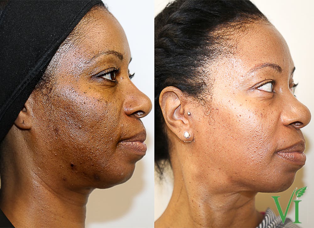 VI Peel Before & After Gallery - Patient 111186 - Image 1