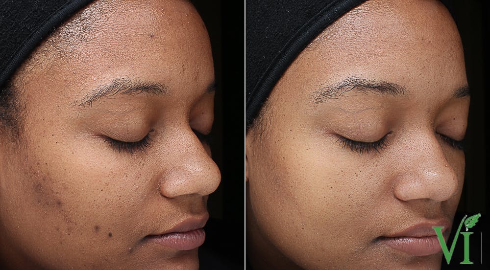 Pigmentation Before & After Gallery - Patient 5640709 - Image 1