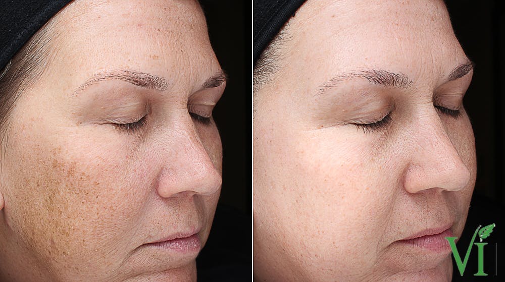 Pigmentation Before & After Gallery - Patient 5640710 - Image 1