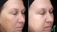 VI Peel Before & After Gallery - Patient 426517 - Image 1