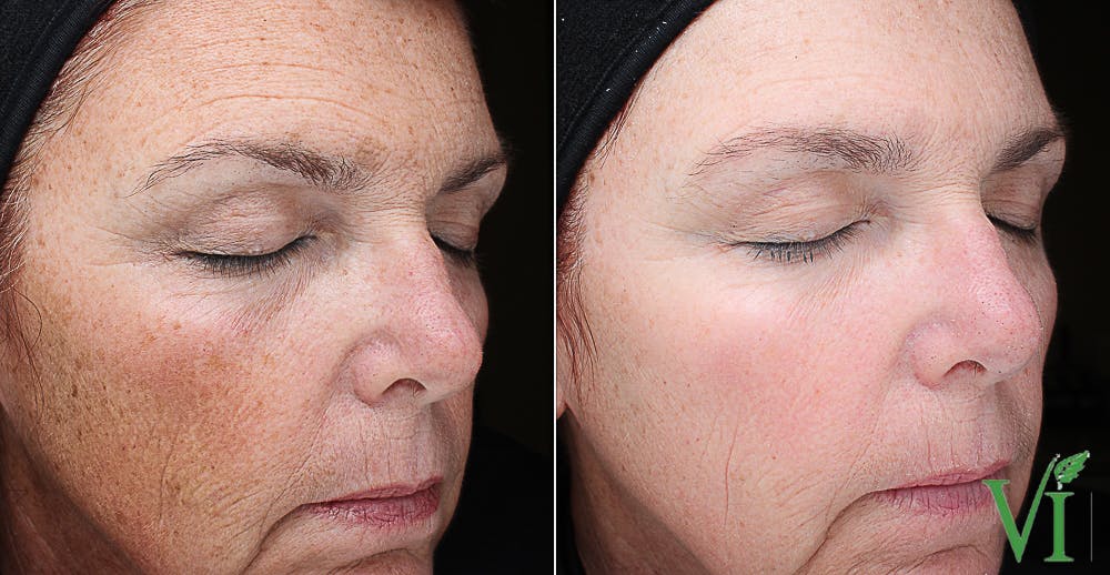 VI Peel Before & After Gallery - Patient 284012 - Image 1