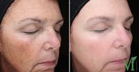 VI Peel Before & After Gallery - Patient 284012 - Image 1