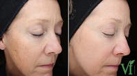 VI Peel Before & After Gallery - Patient 830294 - Image 1