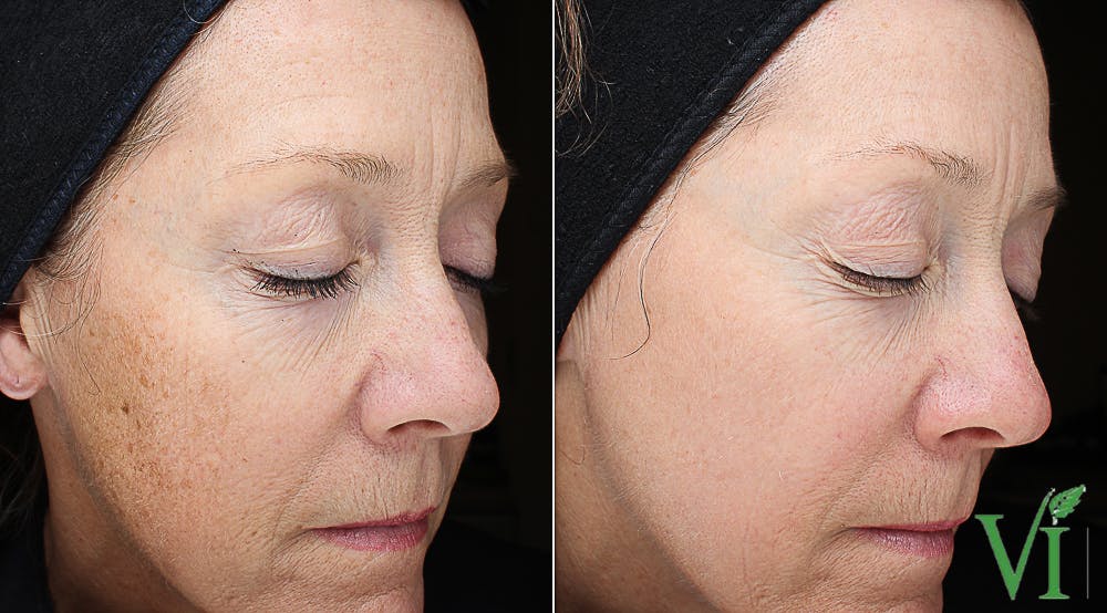 Pigmentation Before & After Gallery - Patient 5640712 - Image 1
