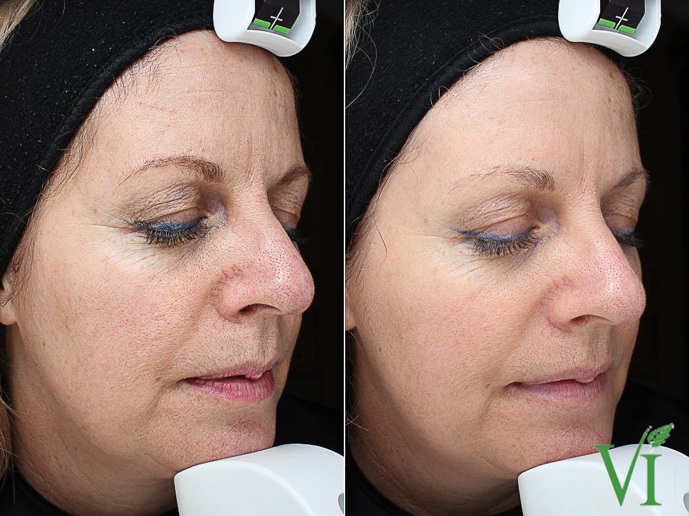 Chemical Peels Before & After Gallery - Patient 346234 - Image 1