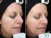 Chemical Peels Before & After Gallery - Patient 346234 - Image 1