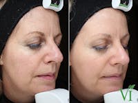 VI Peel Before & After Gallery - Patient 346234 - Image 1