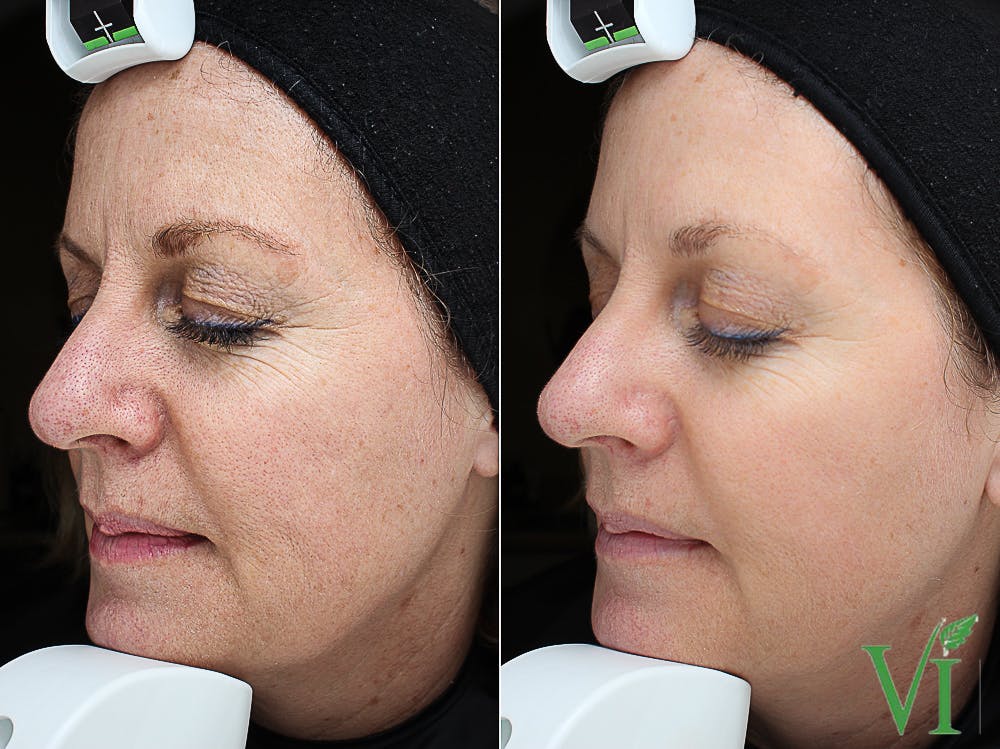 VI Before & After Gallery - Patient 5640716 - Image 2