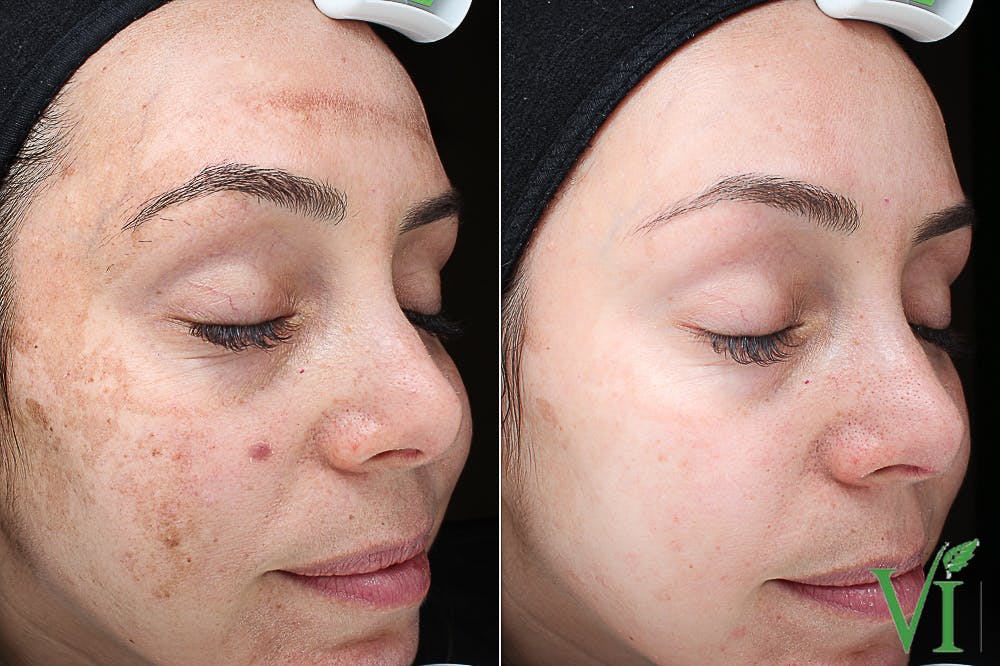 Chemical Peels Before & After Gallery - Patient 154450 - Image 1