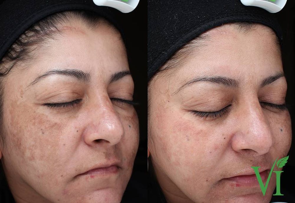 VI Peel Before & After Gallery - Patient 393496 - Image 1