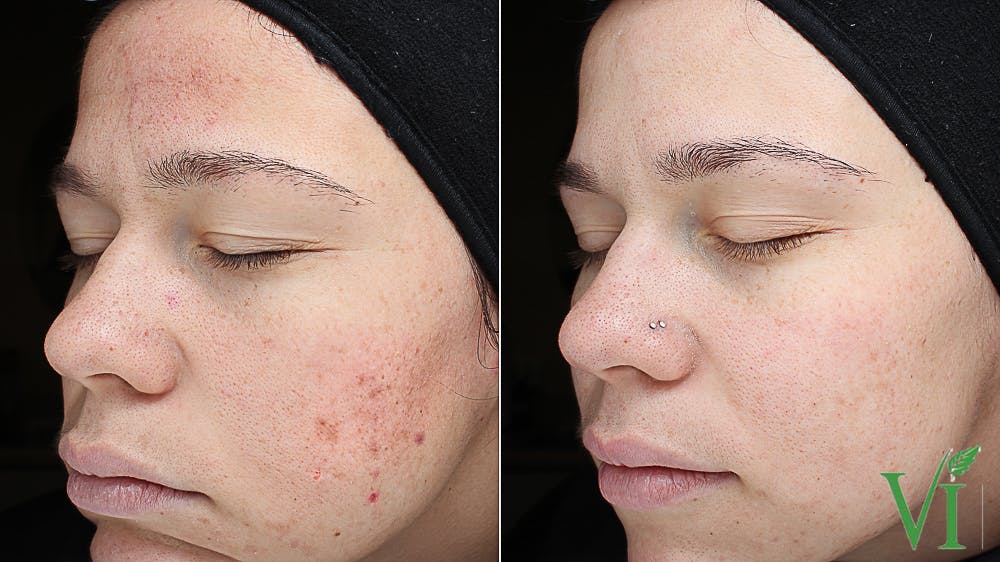 Acne Gallery - Patient 5640906 - Image 1
